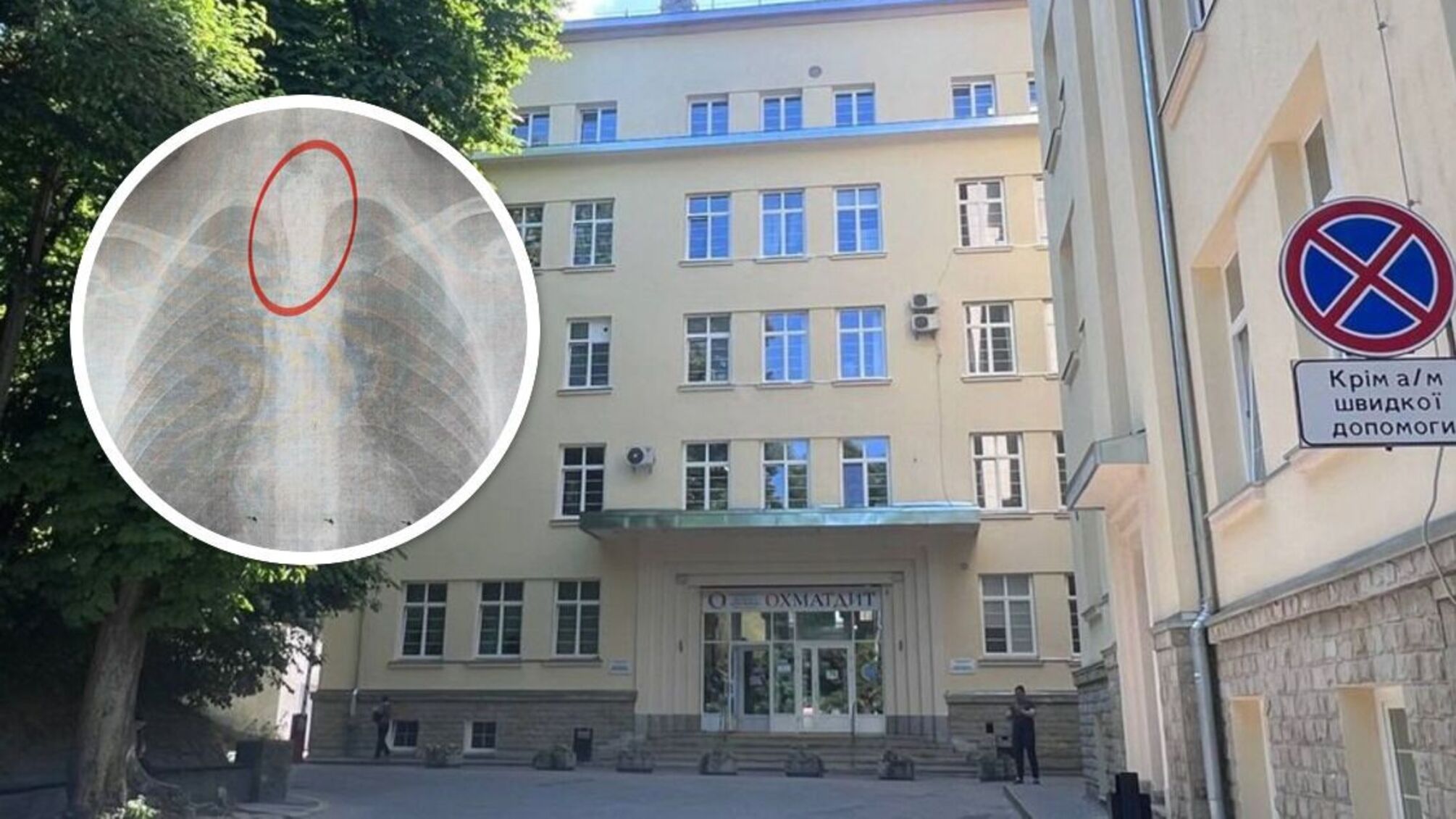 Львовские хирурги удалили застрявший шашлык из пищевода 14-летнего пациента