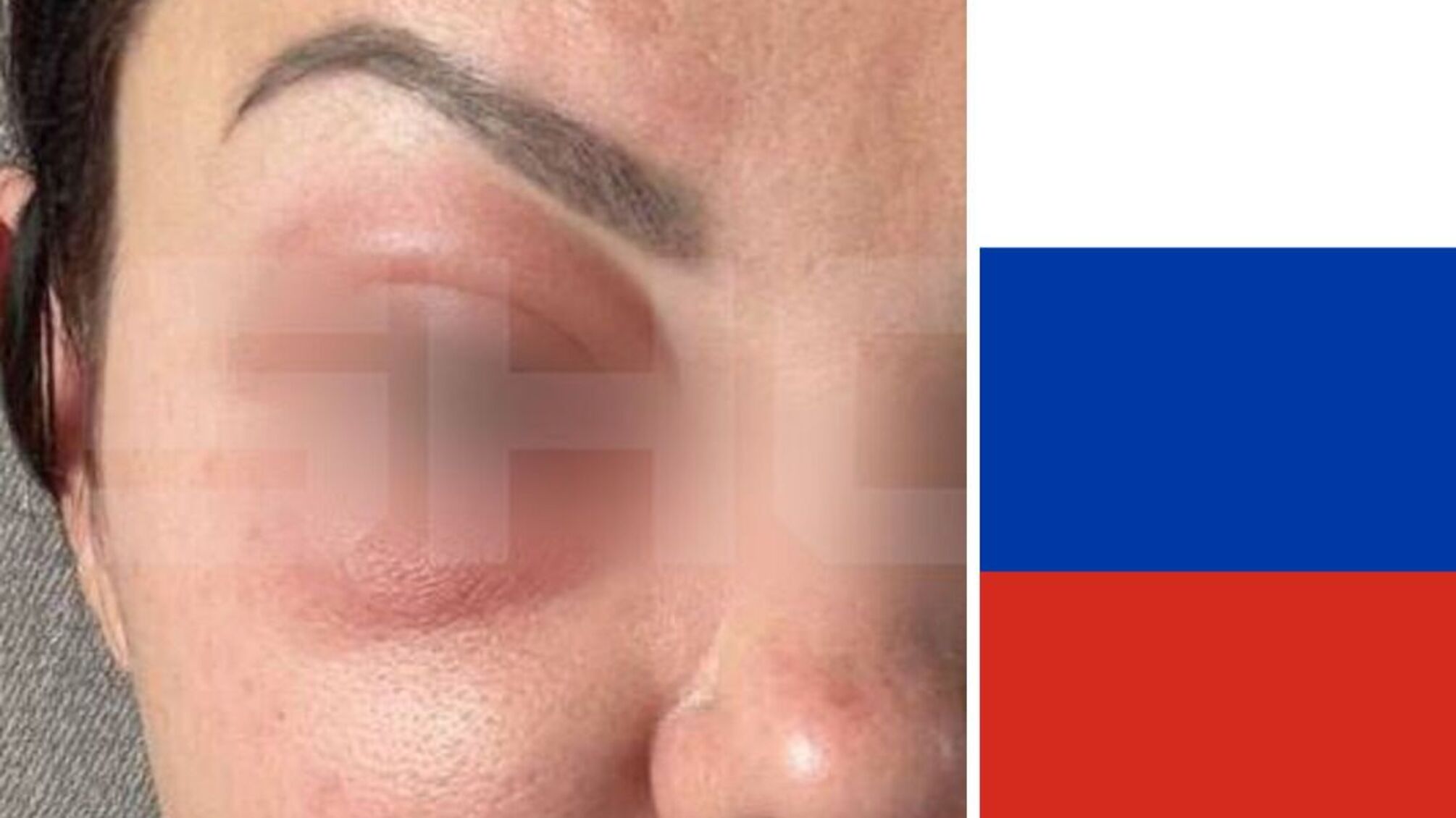 У росії десятки жінок стали жертвами косметології: до введеного їм препарату немає антидотів (фото)