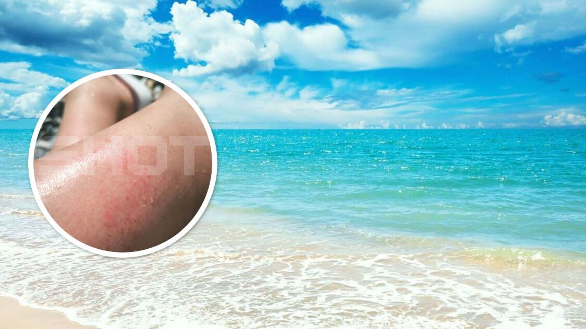 У граждан россии фиксируют массовую аллергию на… море