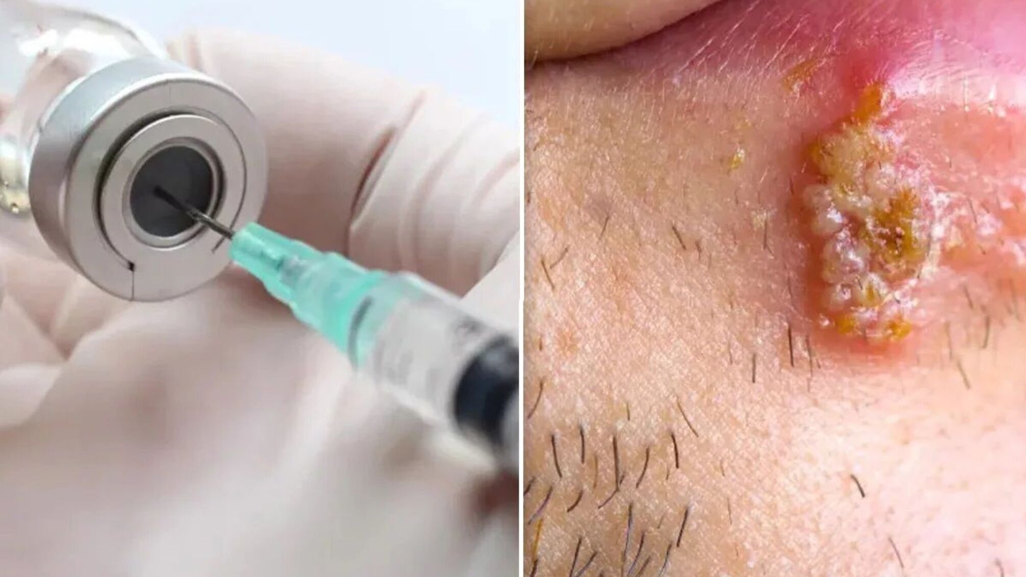 Украина будет защищать девушек от рака шейки матки: государство оплатит прививку от ВПЧ